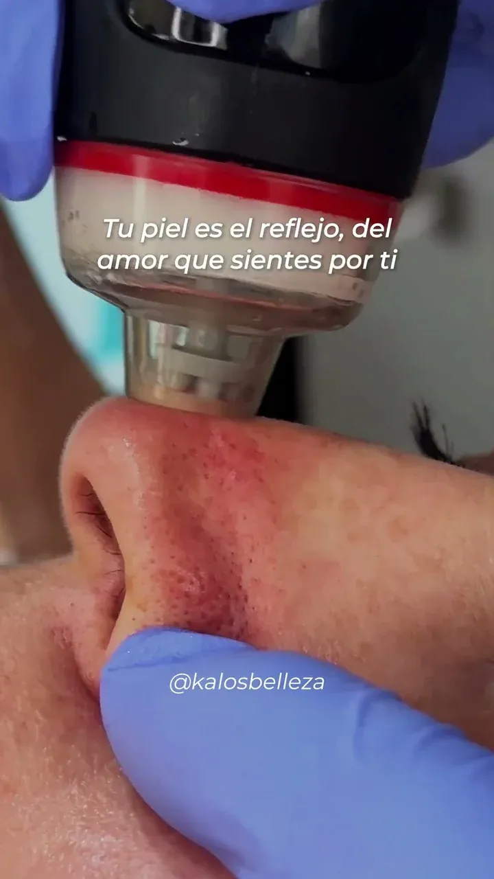 Pieza de mano de DermaClear sobre la nariz de una paciente durante una limpieza facial