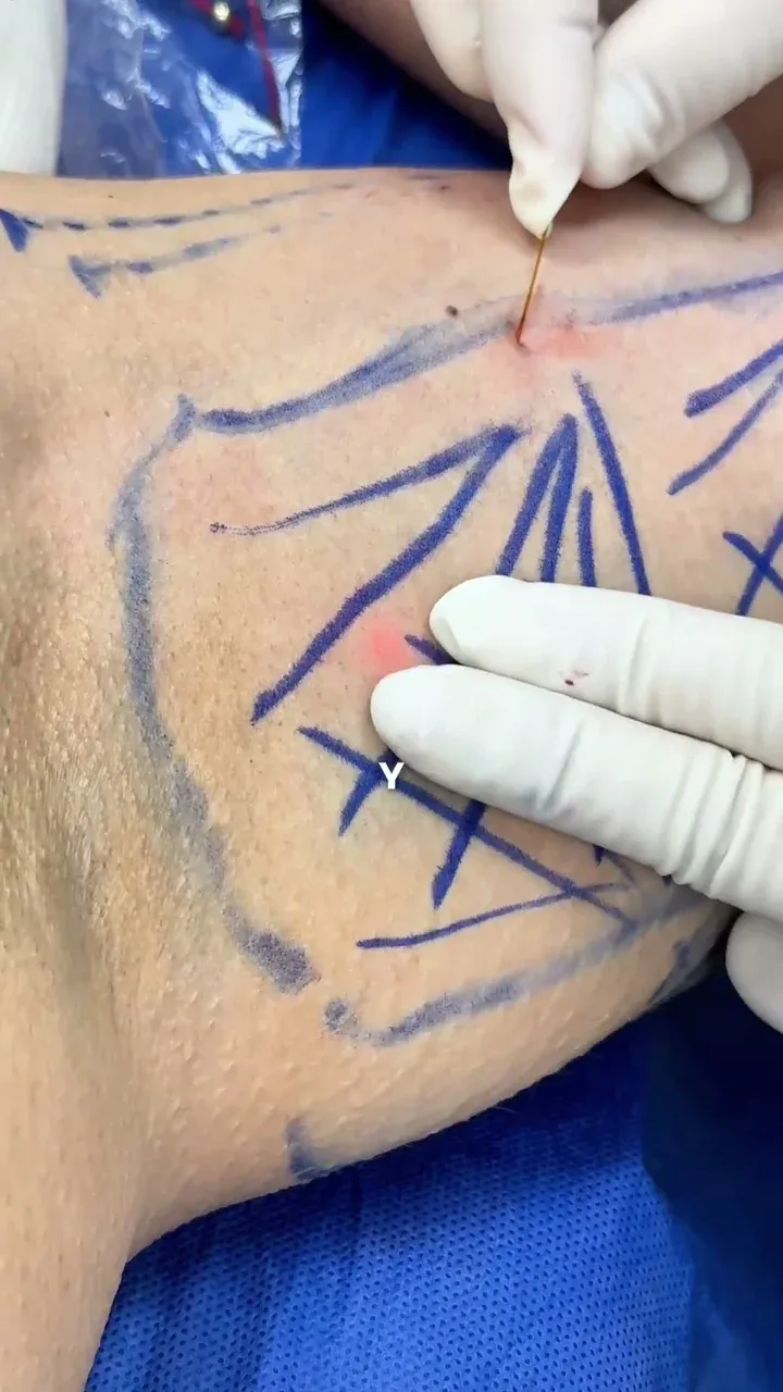 Brazo marcado con líneas guía durante un tratamiento con Endolift