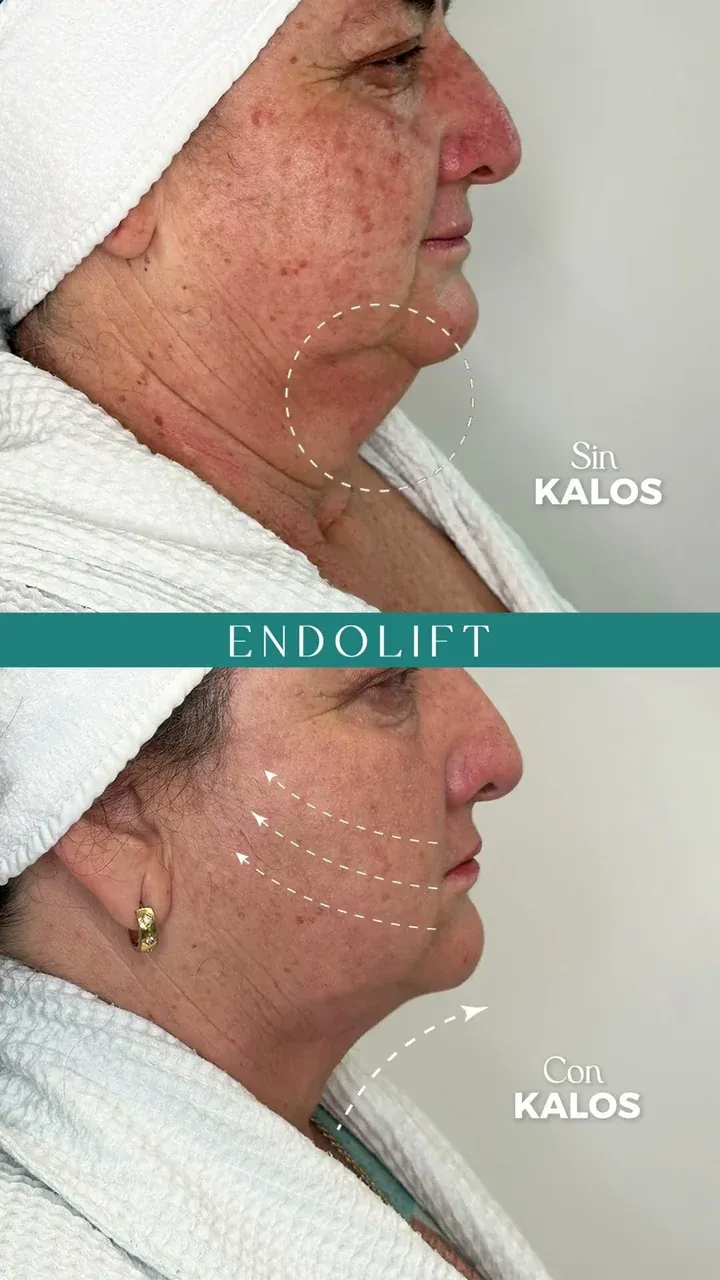Perfil de una paciente antes y después de Endolift en la papada