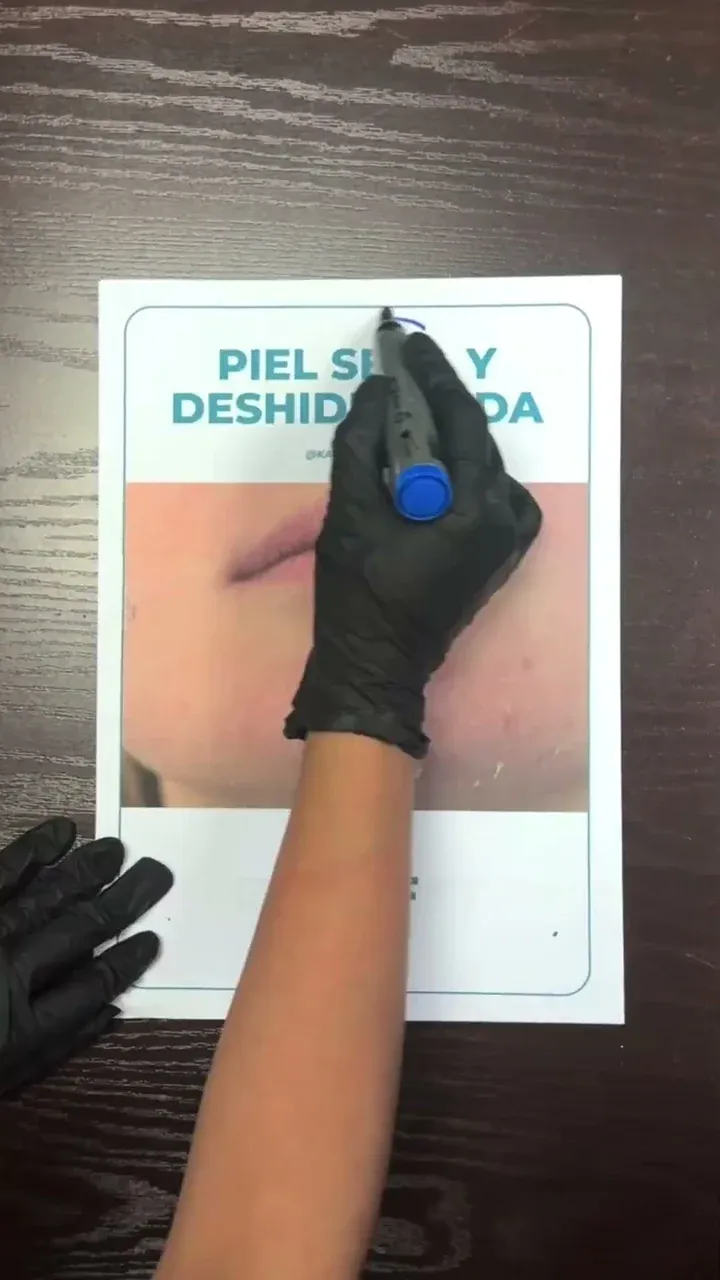 Mano con guante marca con un plumón una lámina sobre piel seca y deshidratada