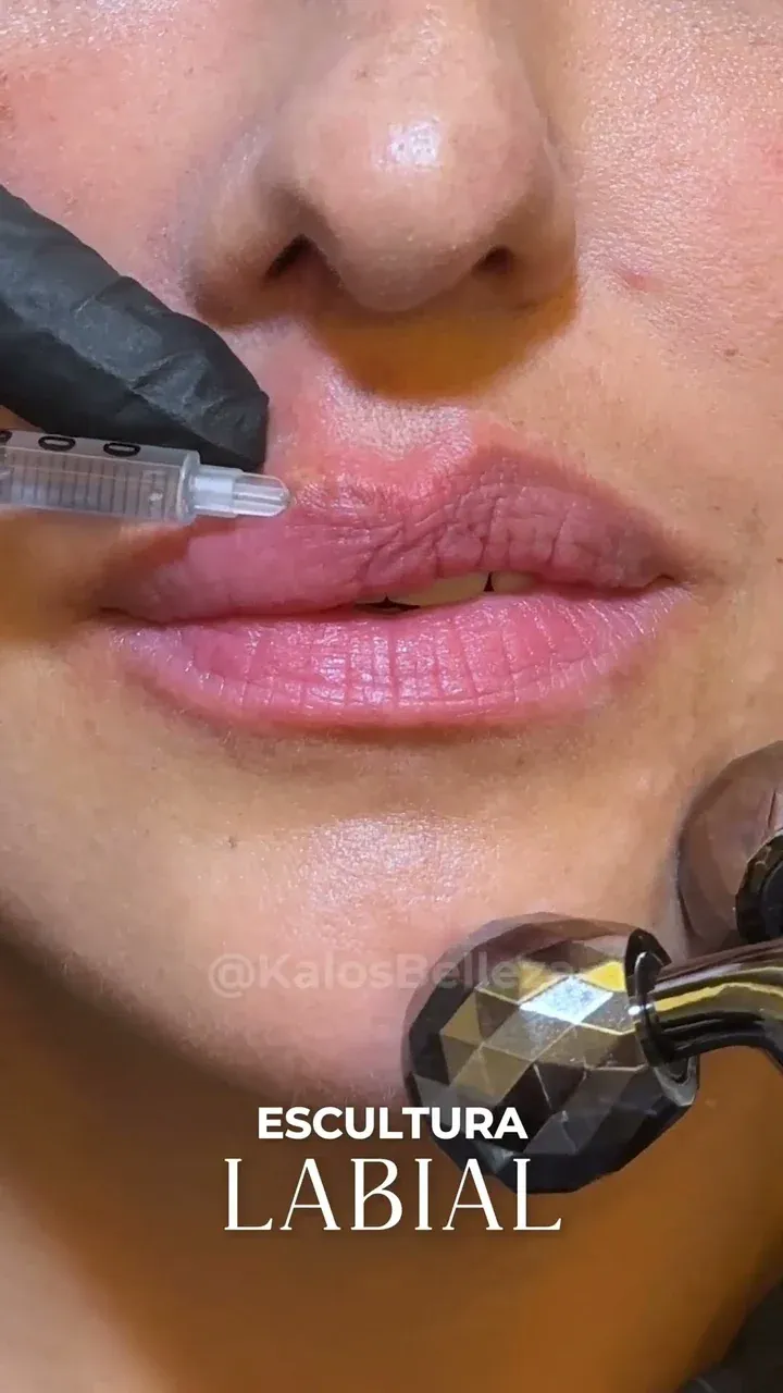 Aplicación de ácido hialurónico en los labios de una paciente