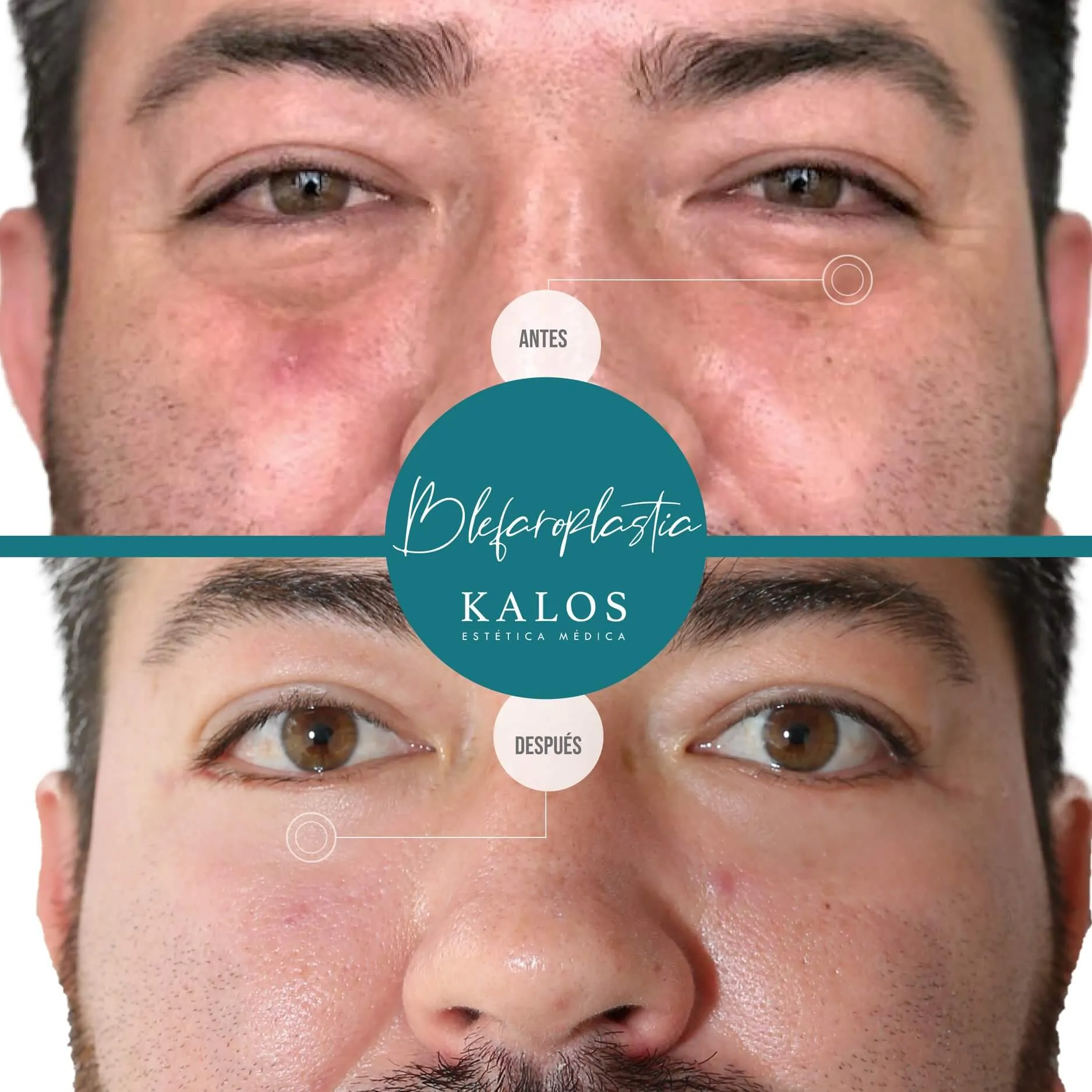 Blefaroplastia Caso de éxito de Blefaroplastia Inferior: A/D