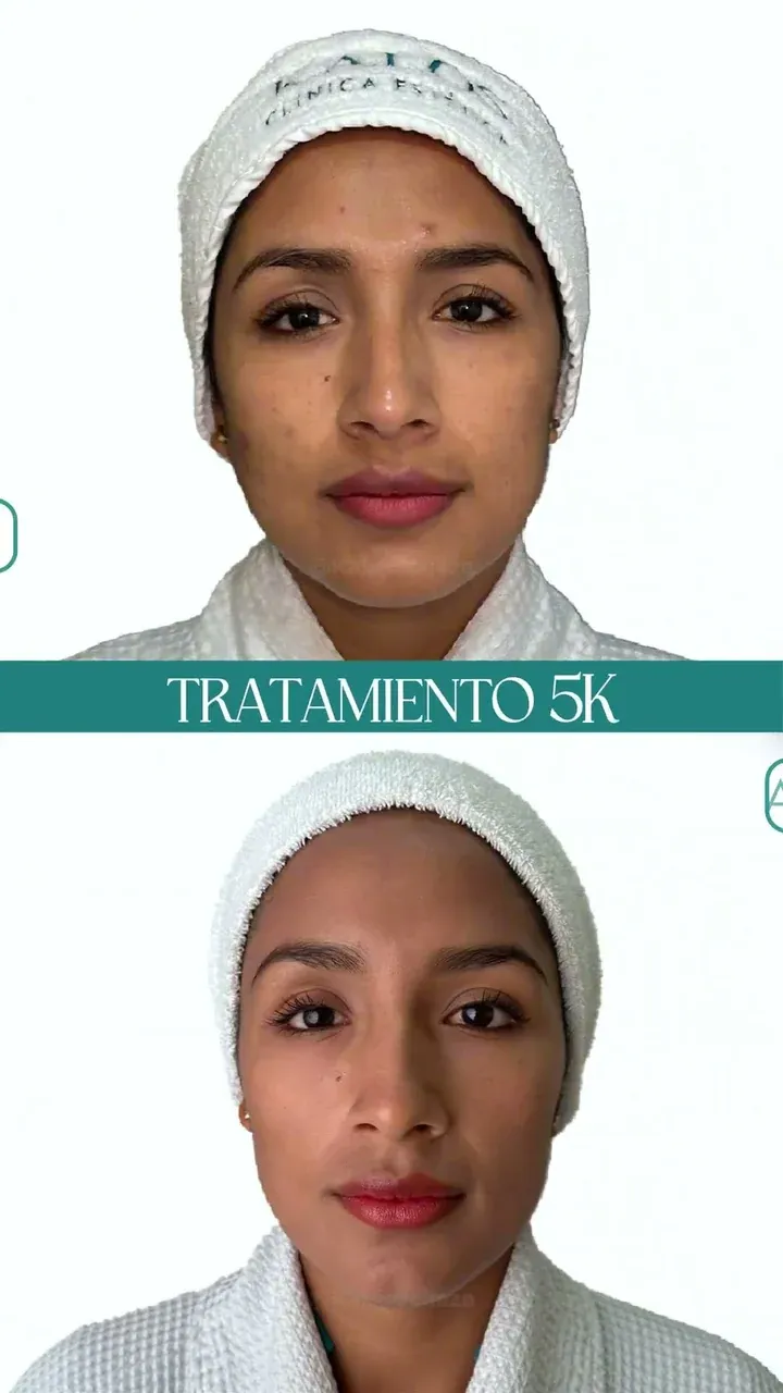 Rostro de una paciente antes y después del tratamiento 5K