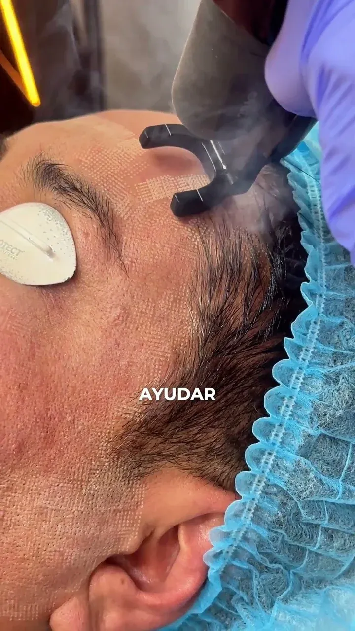 Paciente con protección ocular durante un tratamiento láser facial
