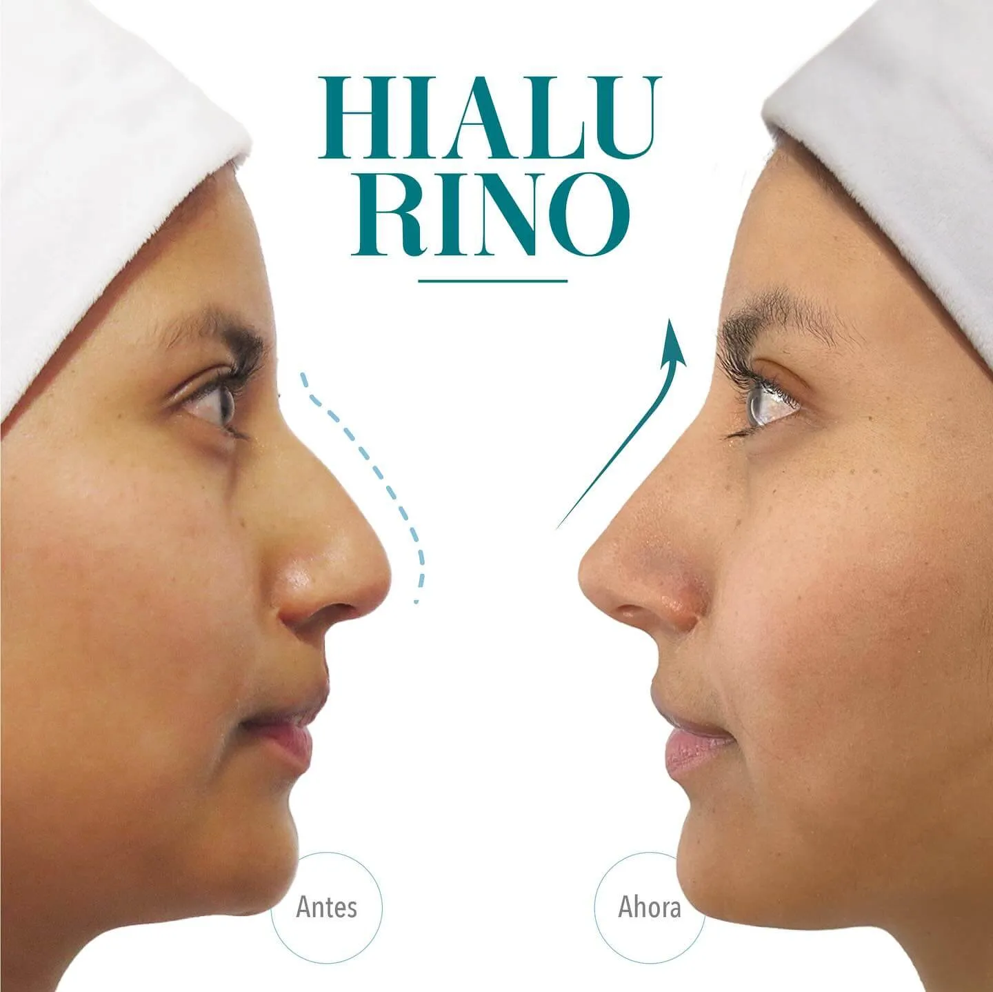 Hialurino Caso de éxito de Hialurino: A/D