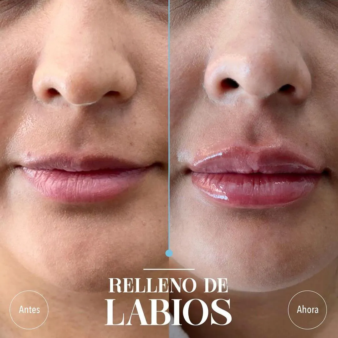 Relleno de Labios Caso de éxito de Relleno de labios: A/D