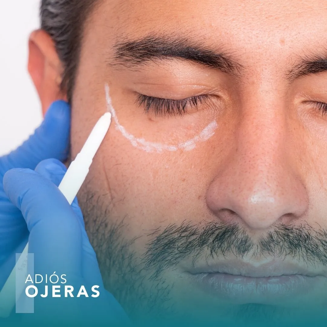 Relleno de Ojeras Relleno de Ojeras