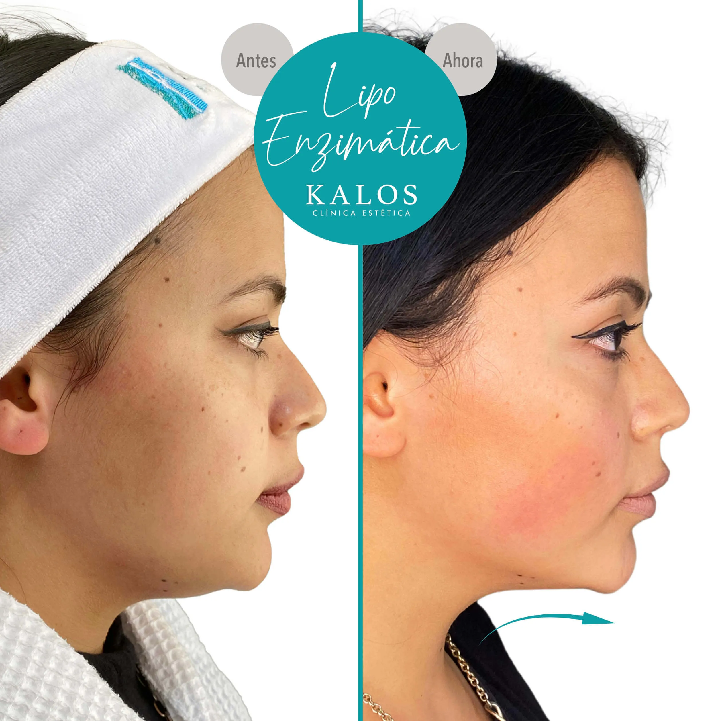 Lipo enzimática Caso de éxito de Lipo enzimática: A/D