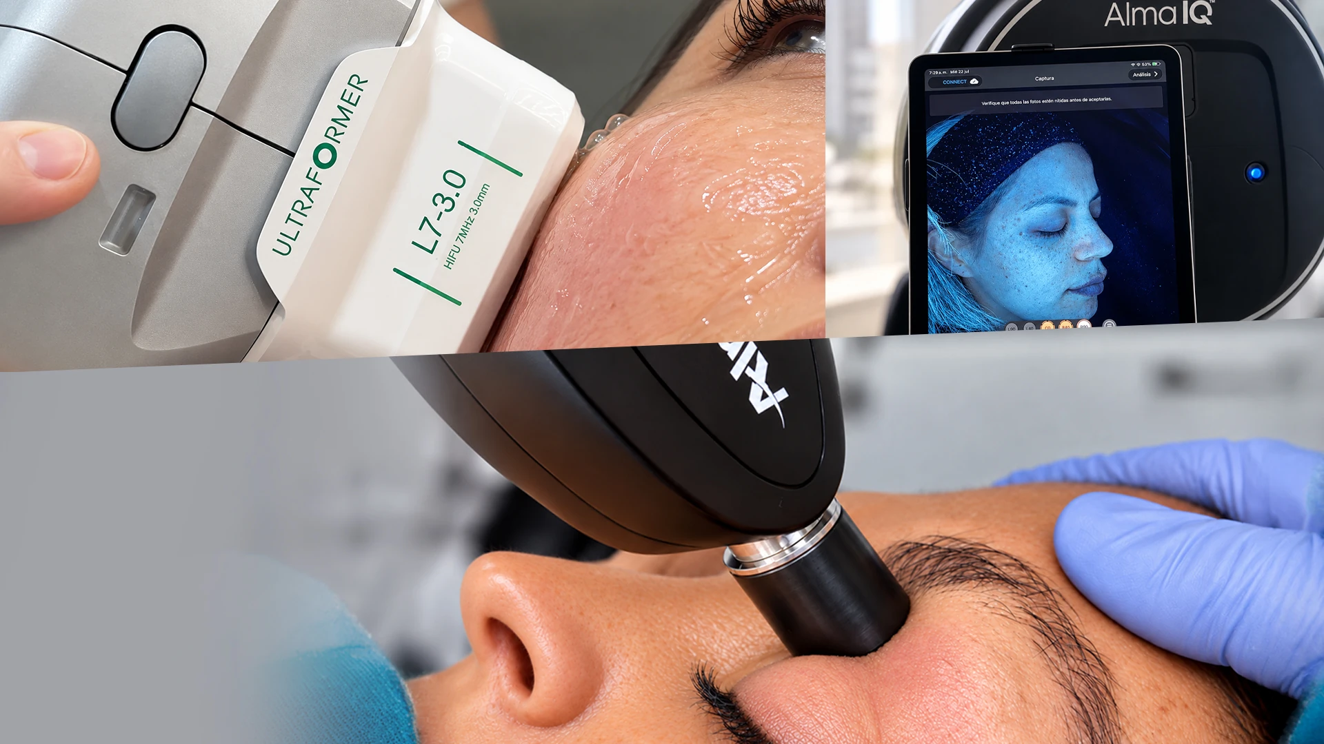 Aparatología en Kalos: Ultraformer, análisis facial Alma IQ y equipo Alma sobre el rostro