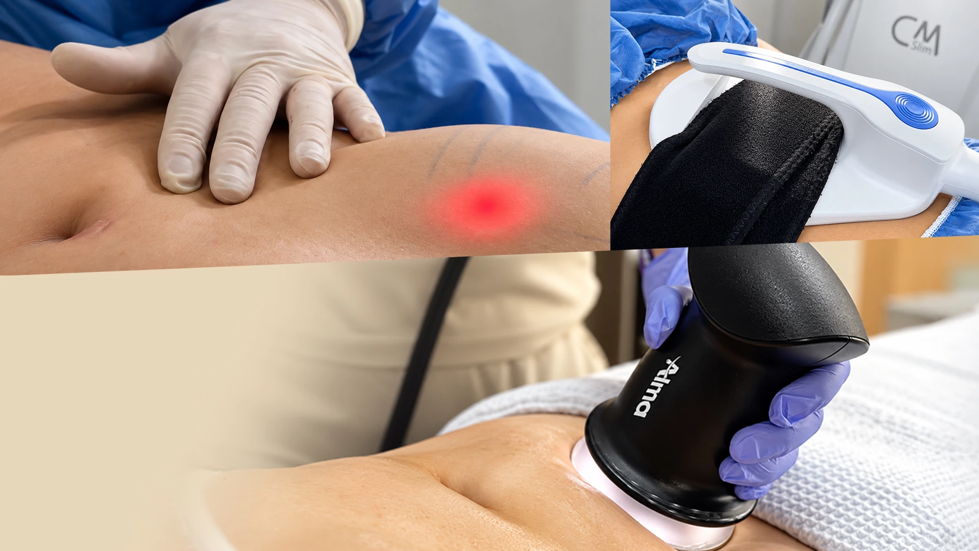 Tratamientos corporales en Kalos con equipos CM Slim y Alma sobre el abdomen