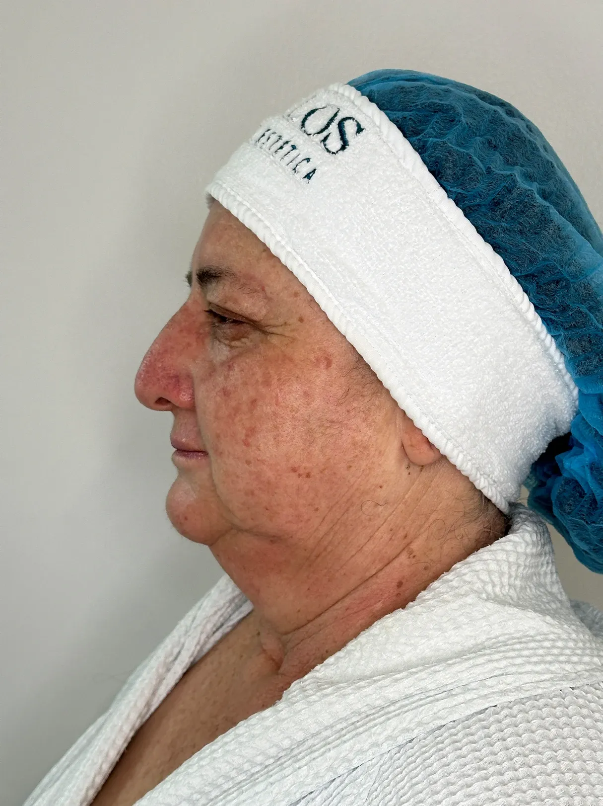 Antes de Endolift: perfil de la papada y el cuello de una paciente