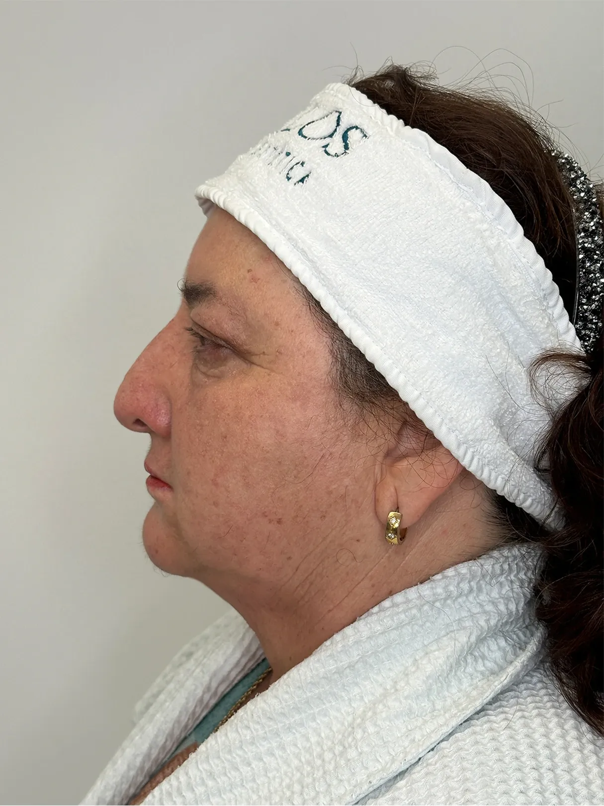 Después de Endolift: perfil de la papada y el cuello de la misma paciente, desde el otro lado