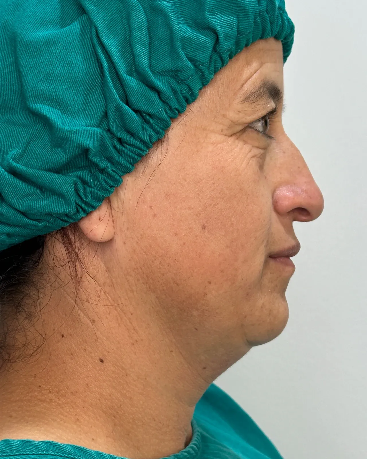 Antes de Endolift: perfil de la papada de una paciente