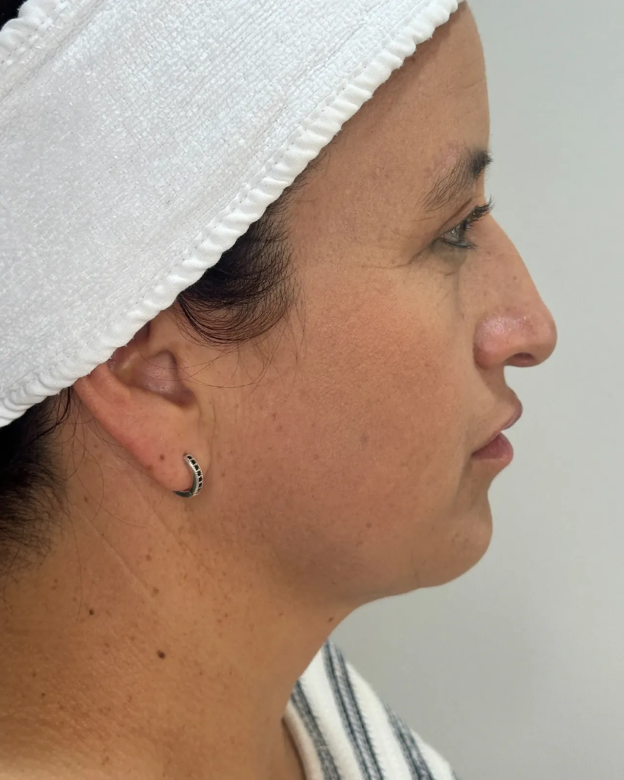 Después de Endolift: el mismo perfil de la papada