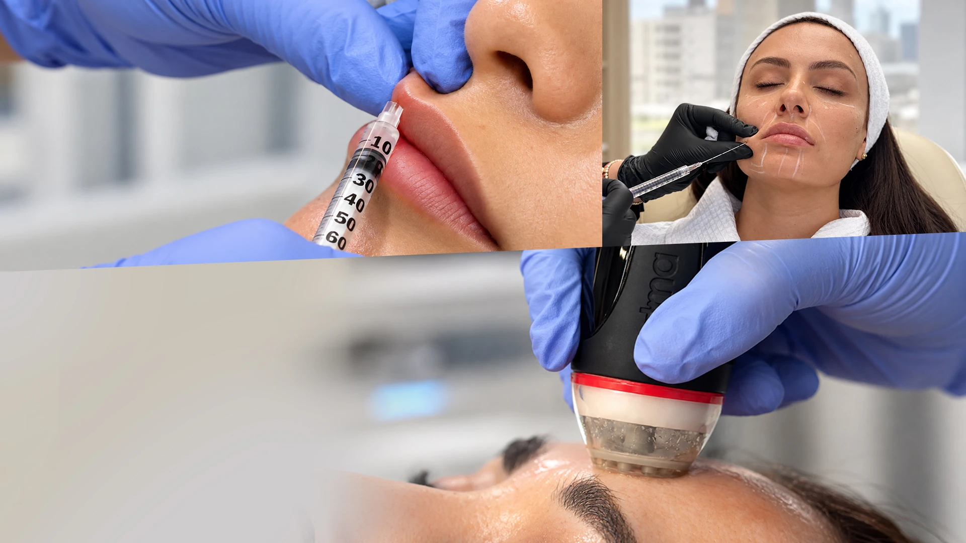 Tratamientos faciales en Kalos: relleno de labios, inyectables y aparatología facial