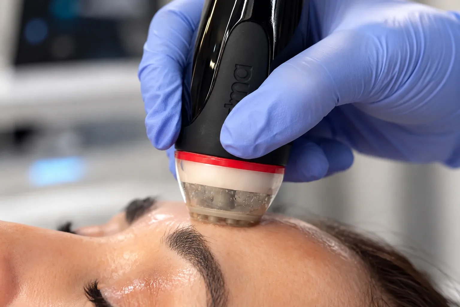 Manos con guantes aplican un equipo facial sobre la frente de una paciente