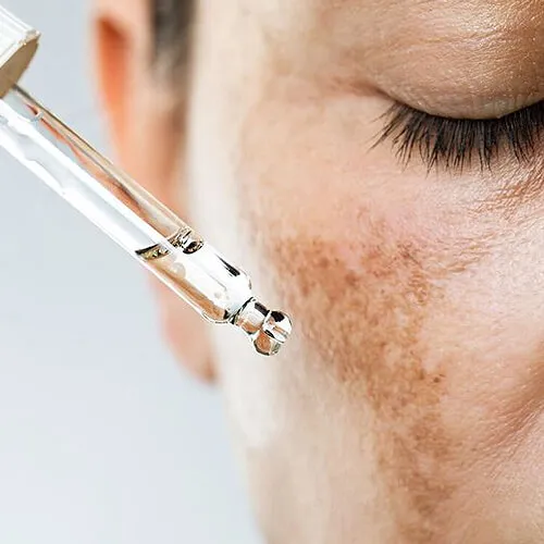 Manchas en la piel: Melasma y otras causas