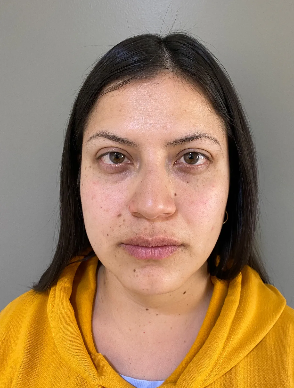 Antes del tratamiento de ojeras: ojos de una paciente con ojeras marcadas