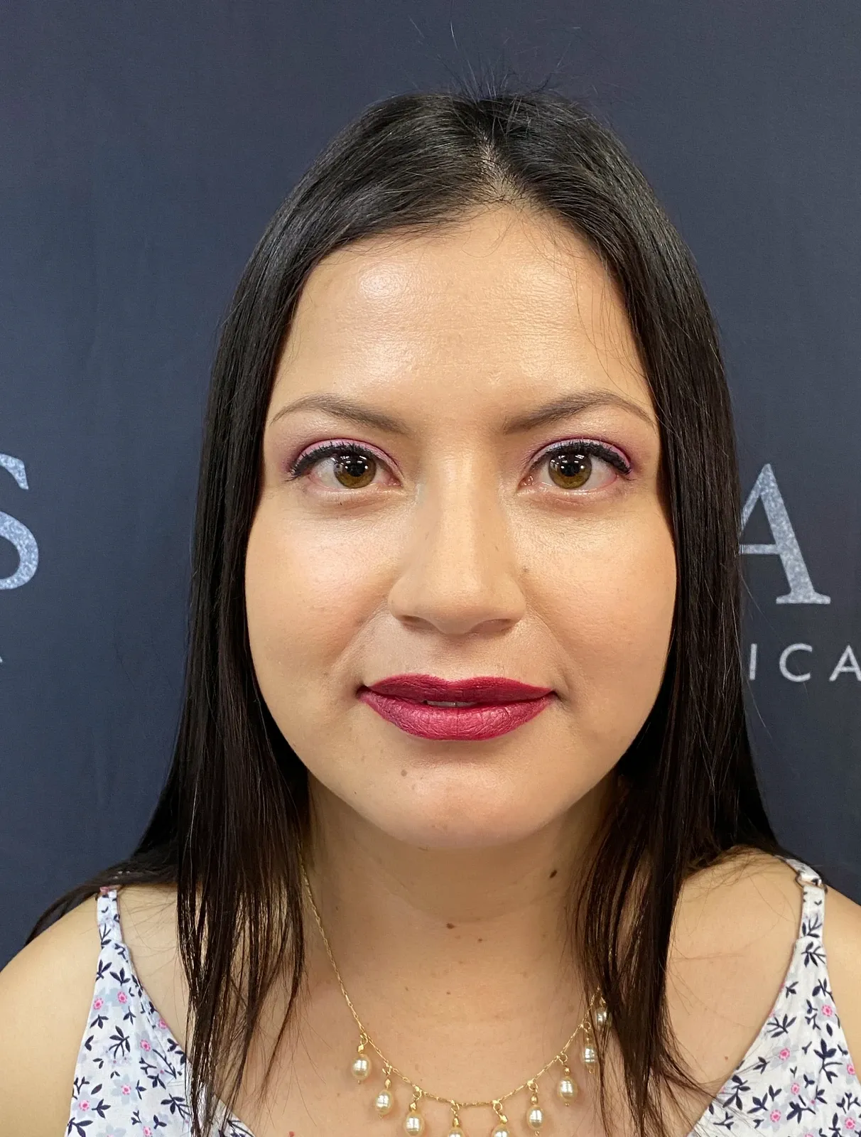 Después del tratamiento de ojeras: los mismos ojos