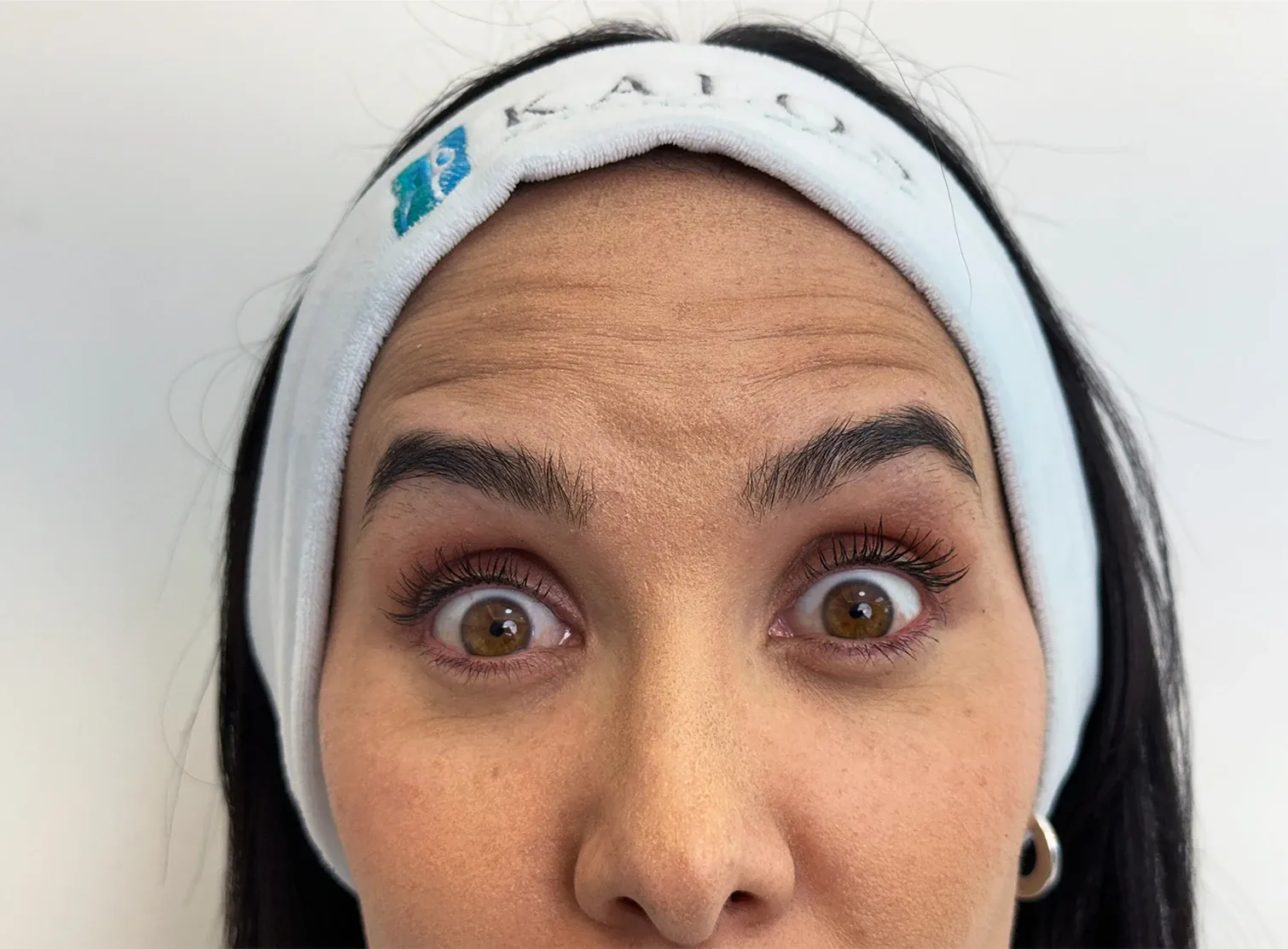 Antes de la toxina botulínica: frente de una paciente con las cejas levantadas