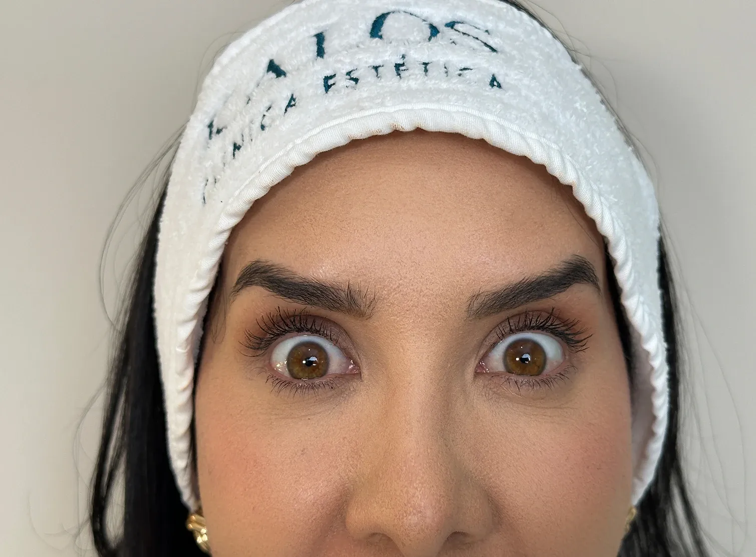 Después de la toxina botulínica: la misma frente con las cejas levantadas