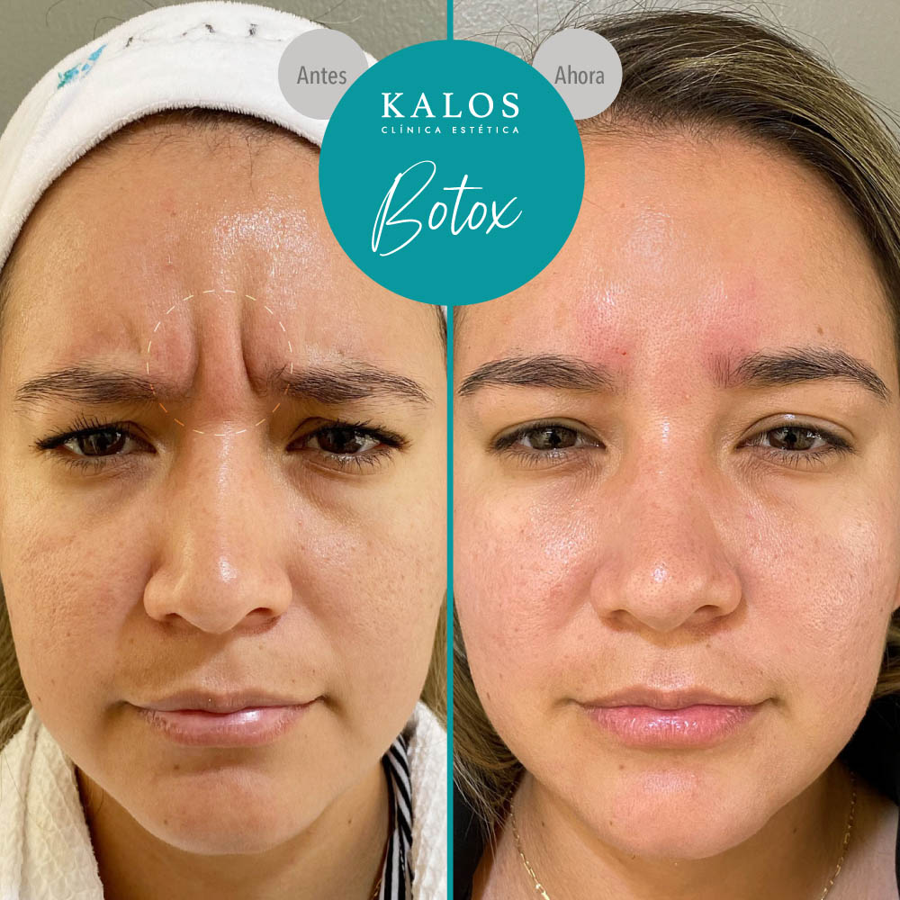 02 BOTOX KALOS QUITO