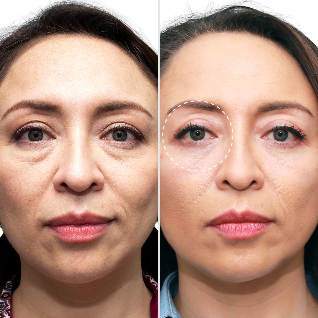 04-BLEFAROPLASTIA-QUITO-KALOS