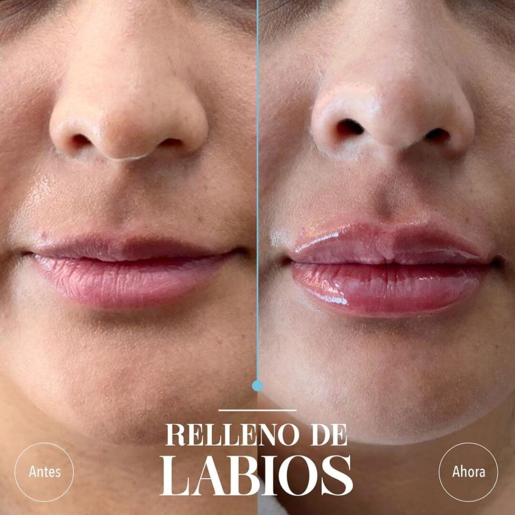 Caso de éxito de Relleno de labios: A/D