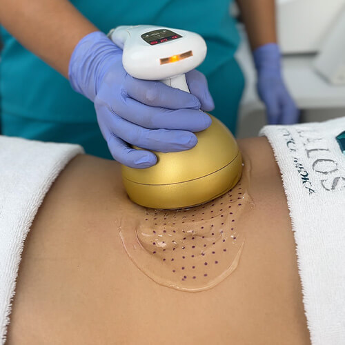 Tecnología que esculpe (Tratamientos corporales)