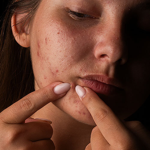 Acné
