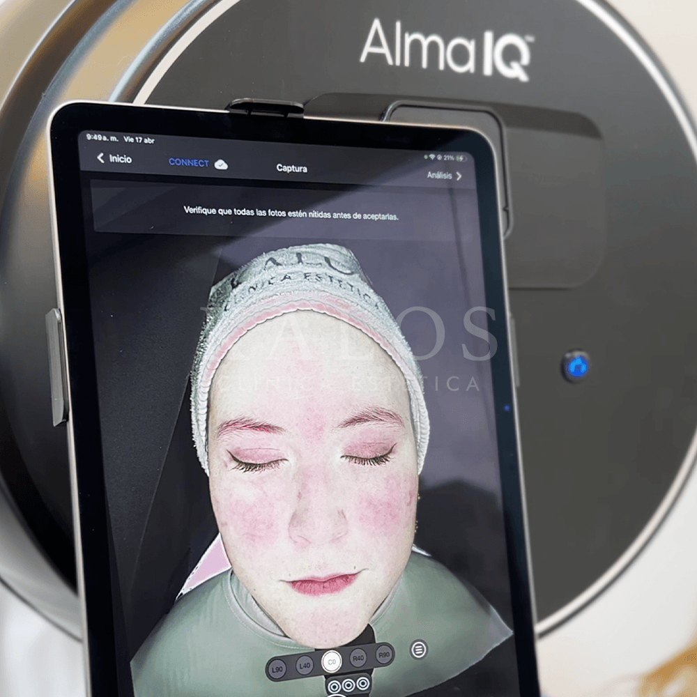 ALMA IQ KALOS (3)